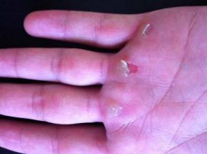 Lifting hand calluses - what?